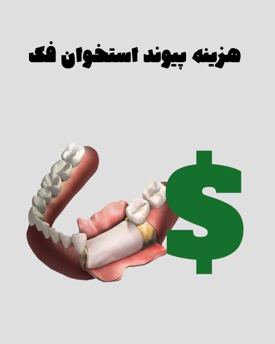 هزینه پیوند استخوان فک برای ایمپلنت