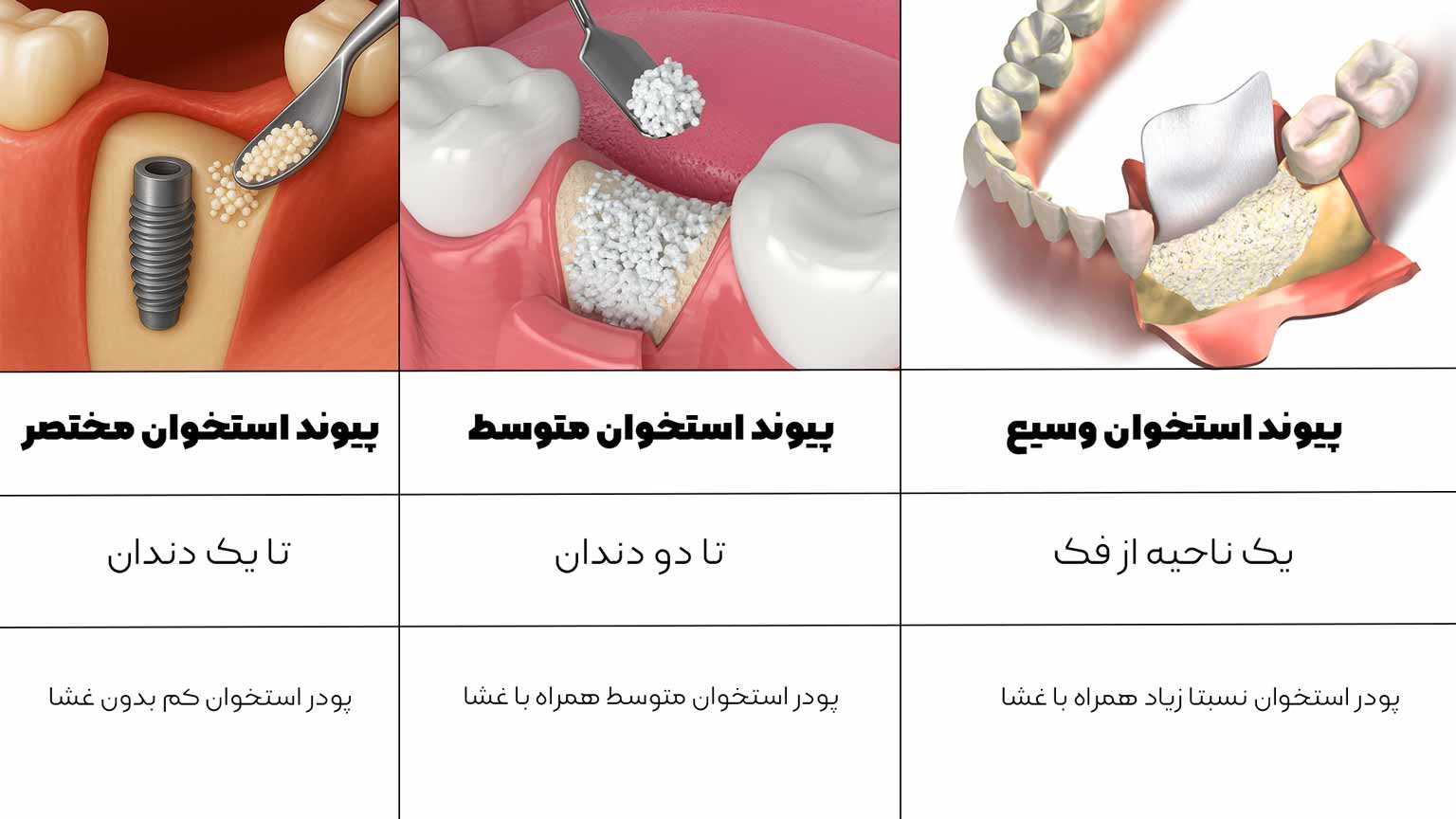هزینه پیوند استخوان فک برای ایمپلنت
