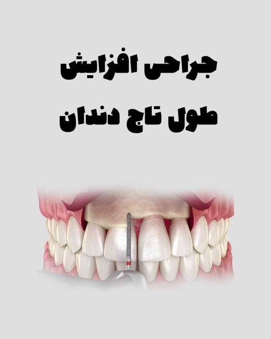 جراحی افزایش طول تاج