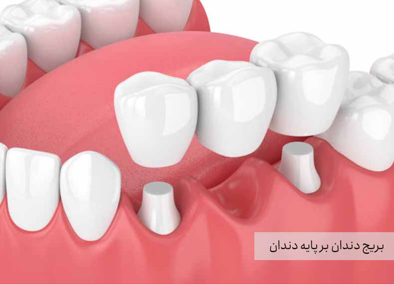 بریج دندان بر پایه دندان
