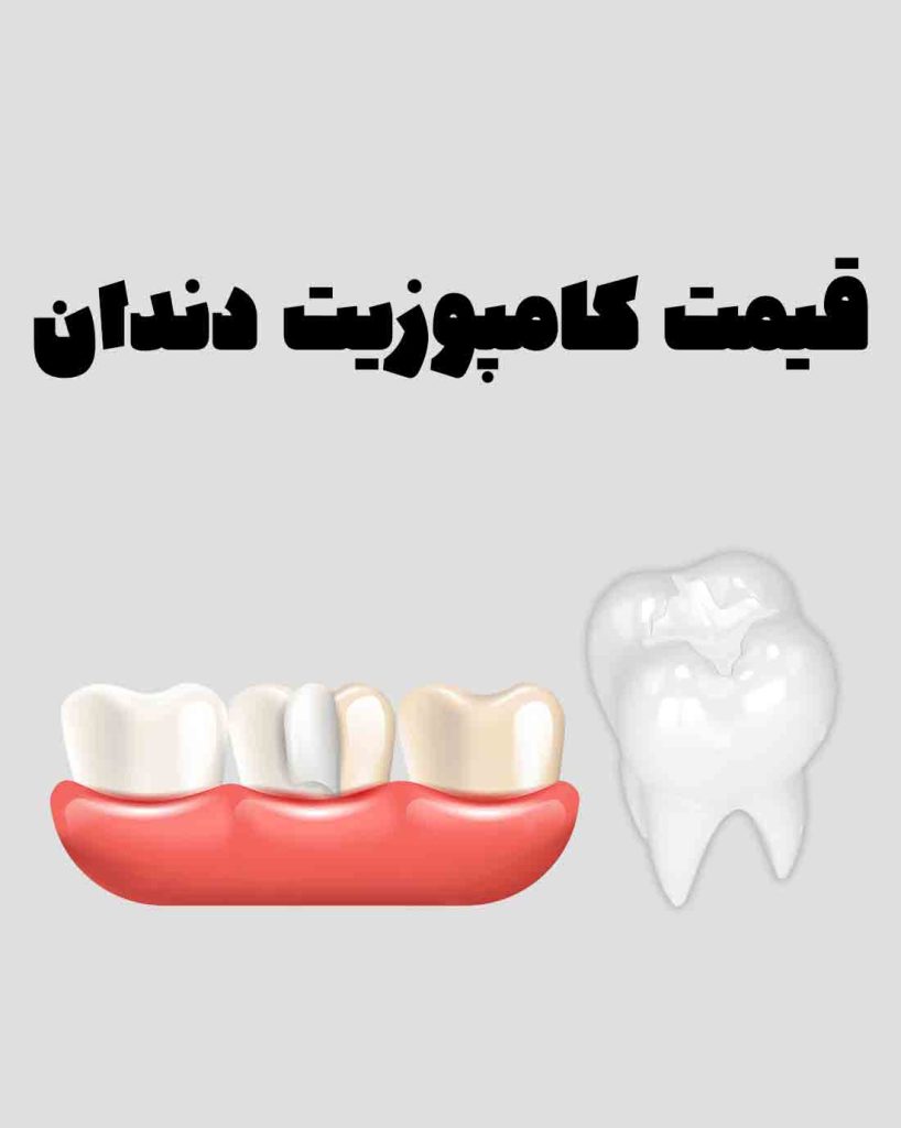 قیمت کامپوزیت دندان