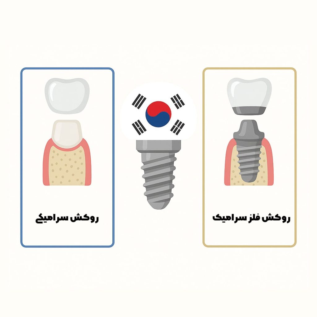 قیمت روکش ایمپلنت کره ای