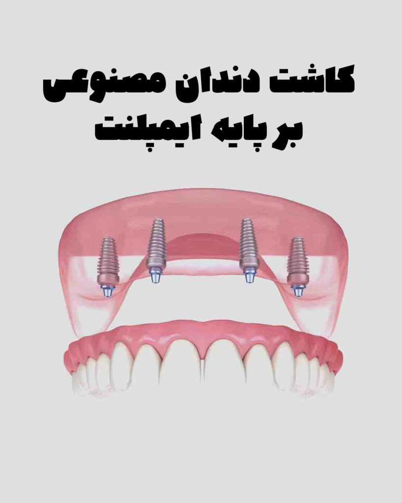 دندان مصنوعی بر پایه ایمپلنت