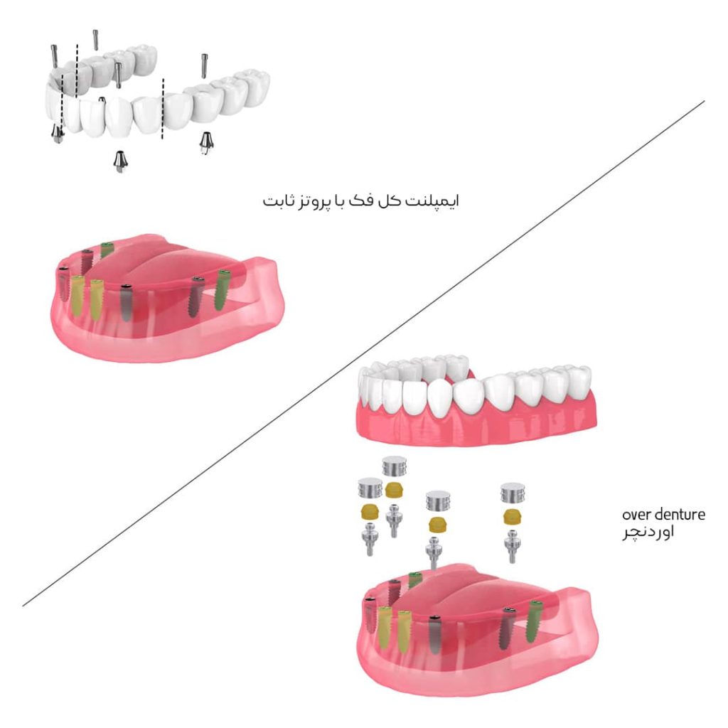 اوردنچر و ایمپلنت کامل فک با پروتز ثابت
