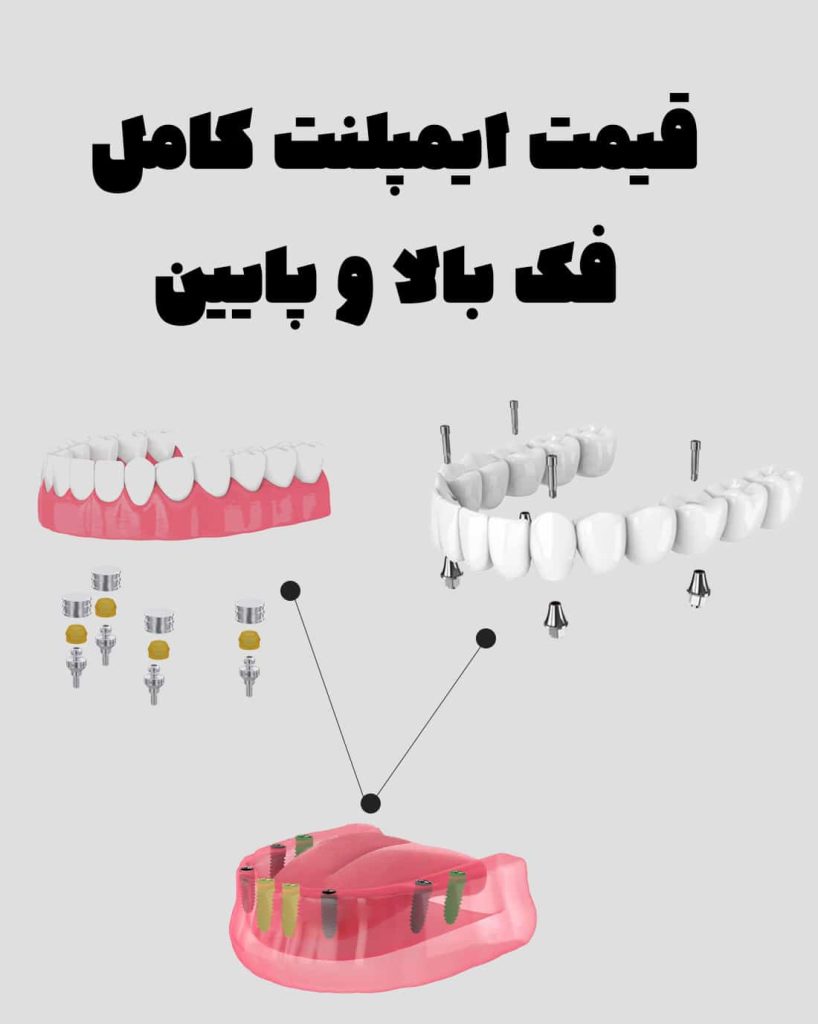 قیمت ایمپلنت کامل فک بالا و پایین