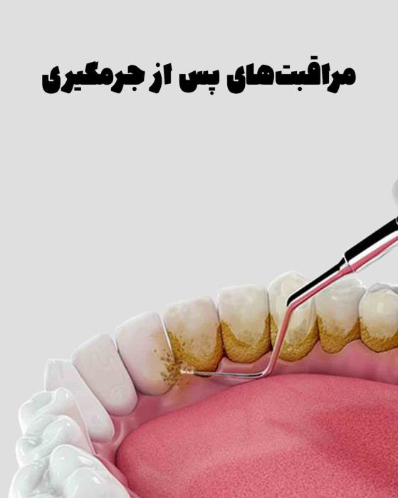 مراقبت‌های پس از جرمگیری