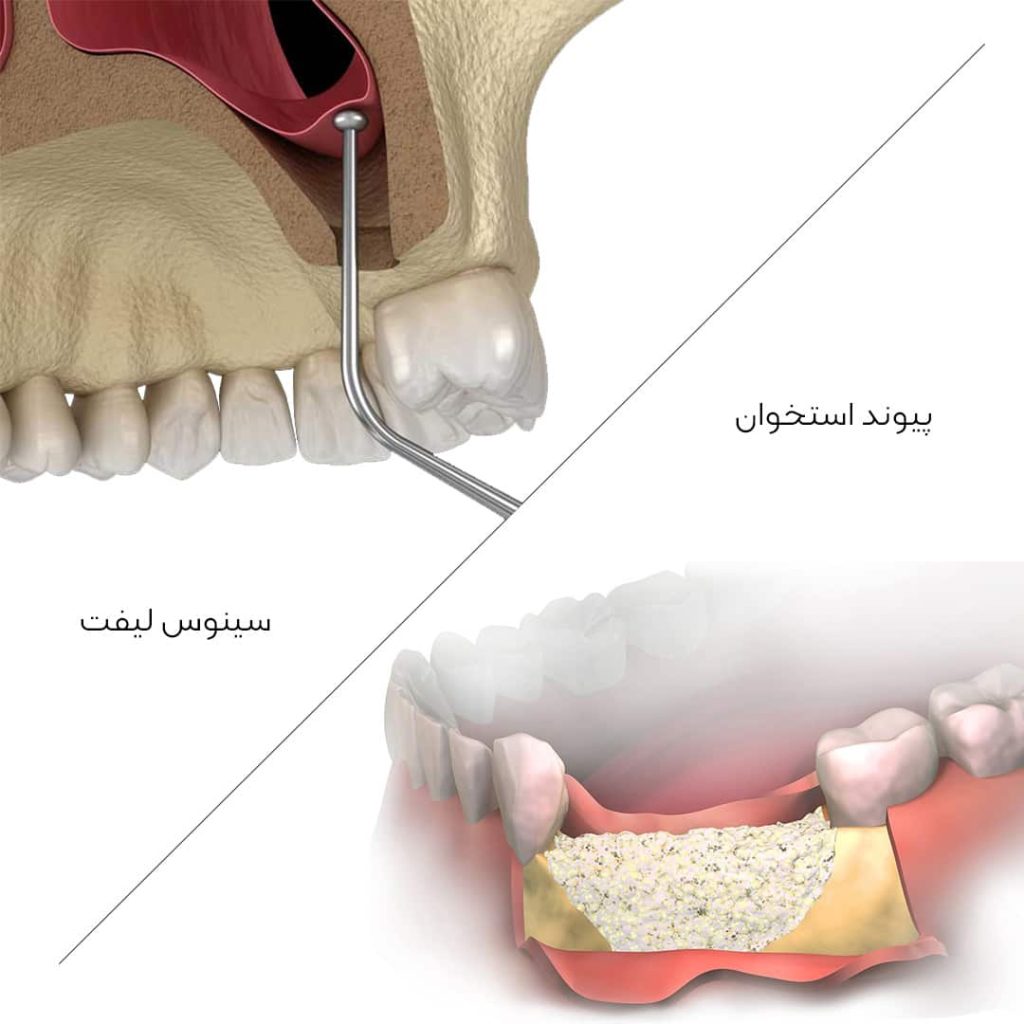 پیوند استخوان و سینوس لیفت