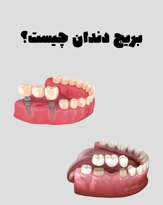 بریج دندان چیست