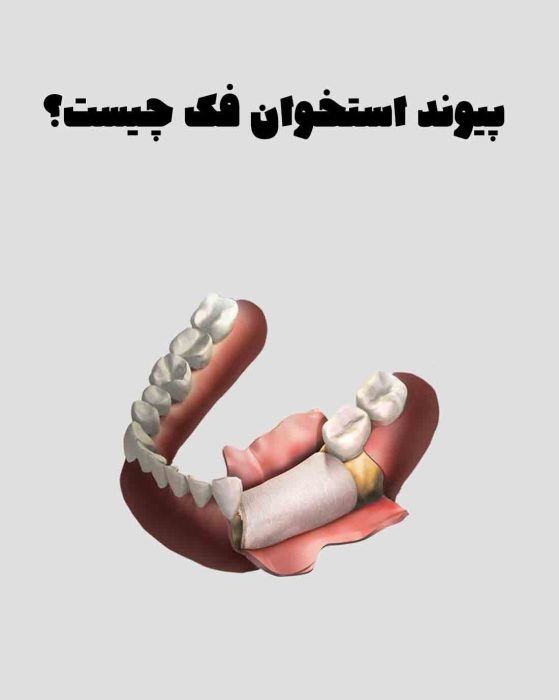 پیوند استخوان فک
