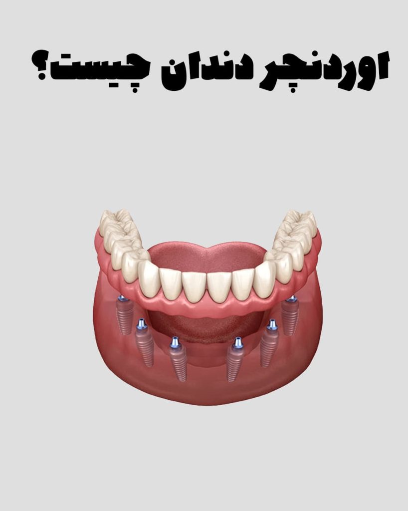 اوردنچر چیست