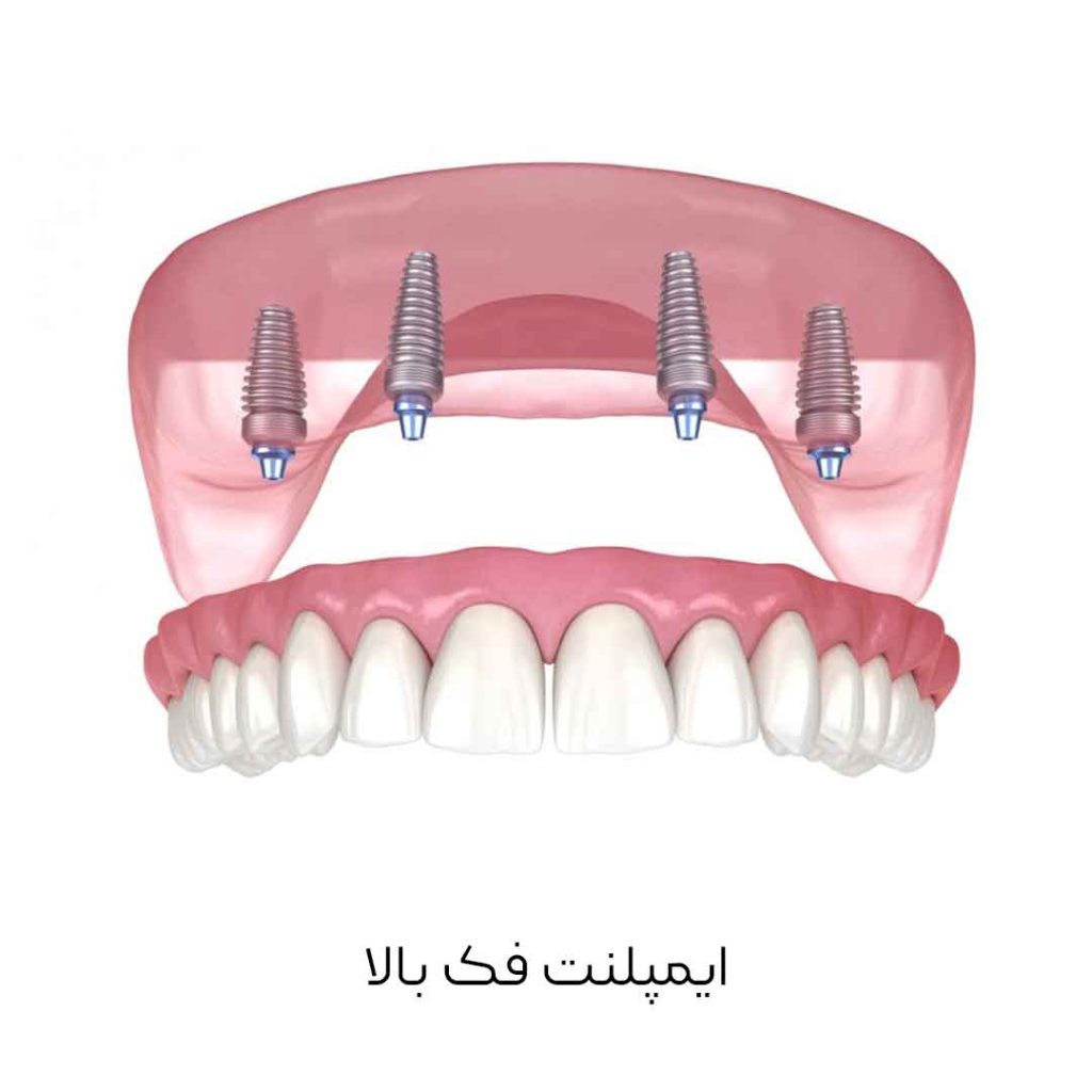 ایمپلنت فک بالا